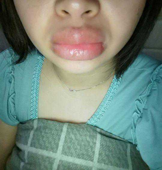 挺了一个月，今天终于进医院了